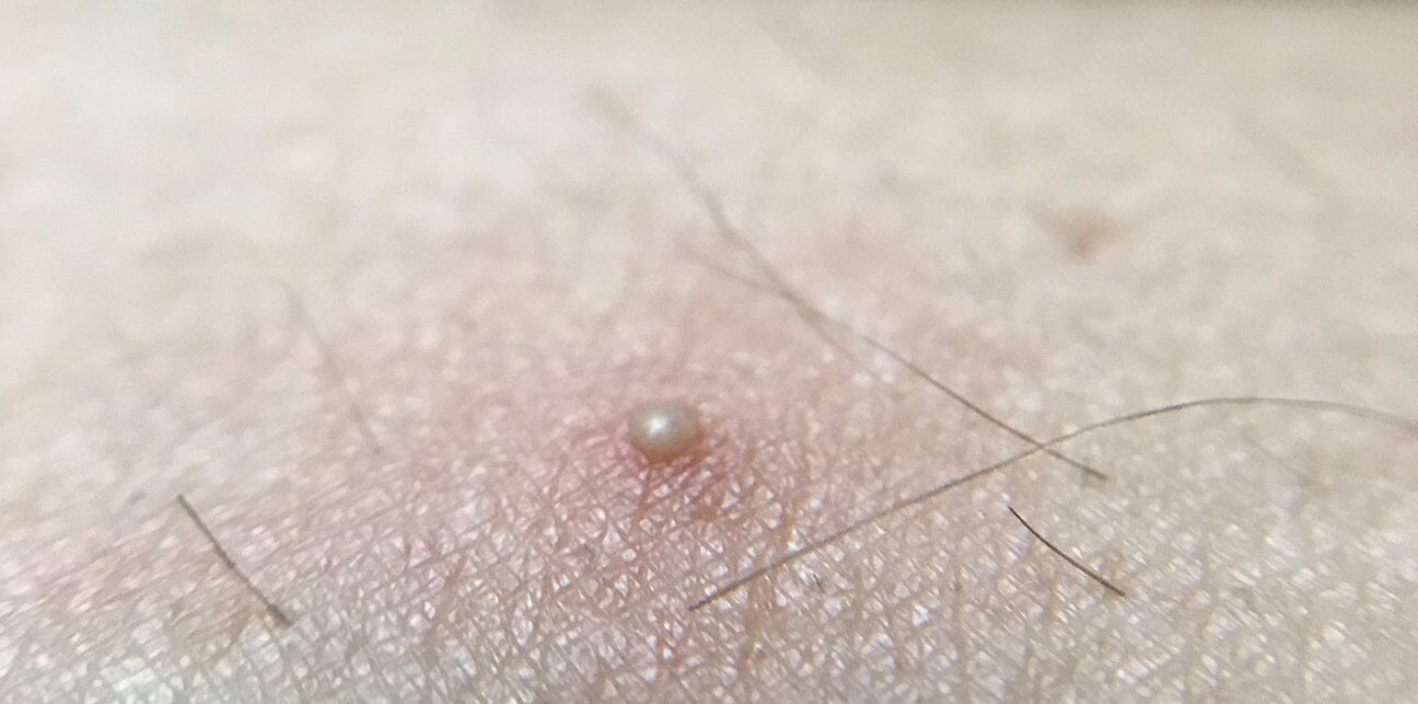 What I Did to Remove My Ingrown Hairs!