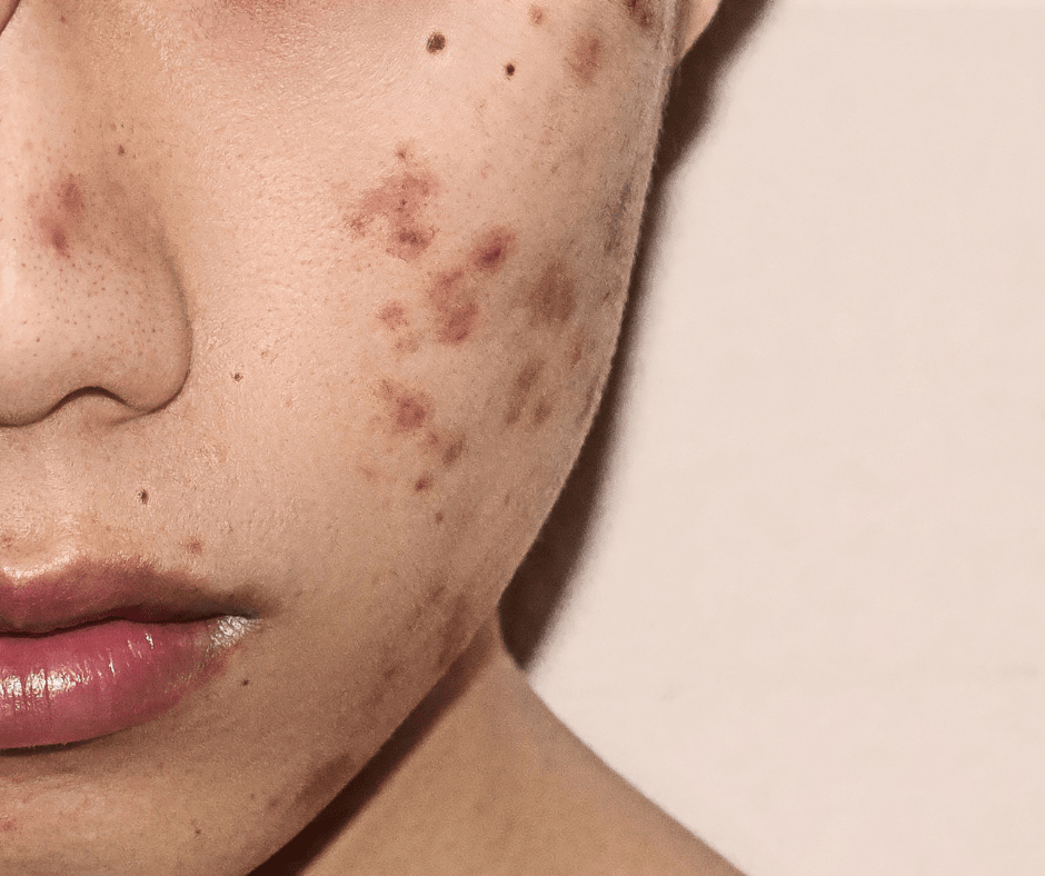 Can You Wax with Acne?